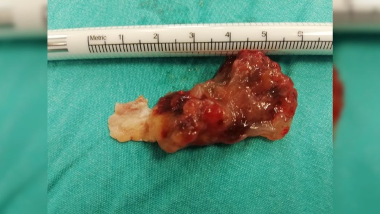 Kalbe yerleşen 5 santimlik tümör ameliyatla alındı!